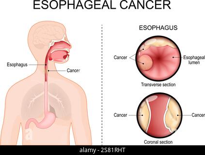 Cancro esofageo. Sezione trasversale e sezione coronale dell'esofago. Adenocarcinoma. Primo piano di un lume esofageo. Profilo umano con stomaco, Illustrazione Vettoriale