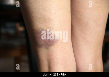 Livido sulla gamba di una donna. Contusione di ematoma dopo lesioni da sport invernali. Foto Stock