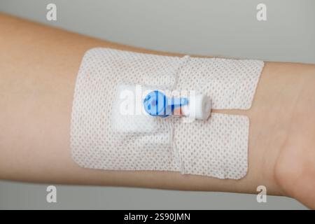 Dispositivo medico. Catetere periferico per la terapia di più giorni Foto Stock