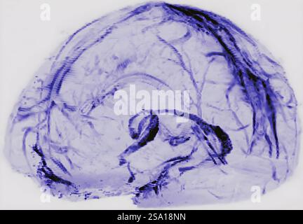 Le scansioni cerebrali di volontari sani hanno dimostrato che il cervello umano può drenare i rifiuti attraverso i vasi linfatici, il sistema fognario bodys. Sistema di drenaggio cerebrale 016555 008 Foto Stock