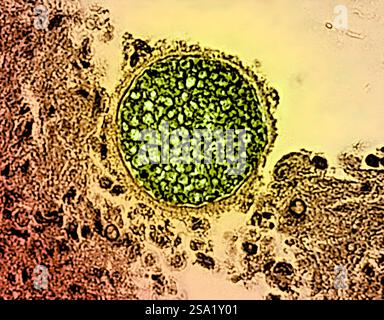 Una sfera fungina di Coccidioides verde presente in un campione di tessuto. Questo organismo provoca la coccidioidomicosi, nota anche come febbre della valle. Credito: Micrografia di colorazione CDC ed effetti visivi di NIAID. Febbre della valle/Coccidioides fungine sferule 016931 039 Foto Stock