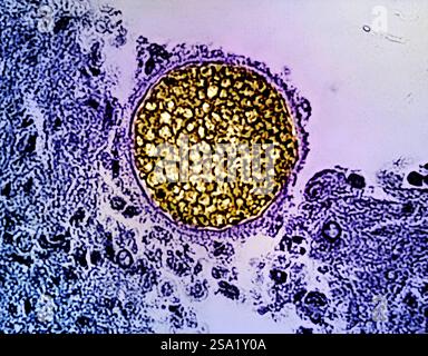 Una sfera micotica di Coccidioides gialla trovata in un campione di tessuto. Questo organismo provoca la coccidioidomicosi, nota anche come febbre della valle. Credito: Micrografo di CDC colorizzazione ed effetti visivi di NIAID Vedi correlati 20 settembre 2024 NIAID Now articolo, &quotazione settimana di sensibilizzazione della malattia di Fungal combattere funghi al NIAID,&quot at. Febbre della valle/Coccidioides fungine sferule 016931 043 Foto Stock