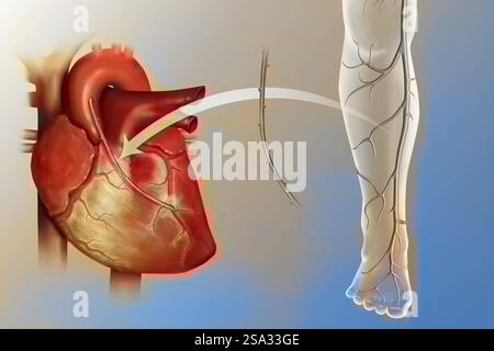Innesto di bypass coronarico. L'ostruzione di un vaso coronarico in giallo da una placca ateromatosa viene compensata dal posizionamento di un bypass. Foto Stock