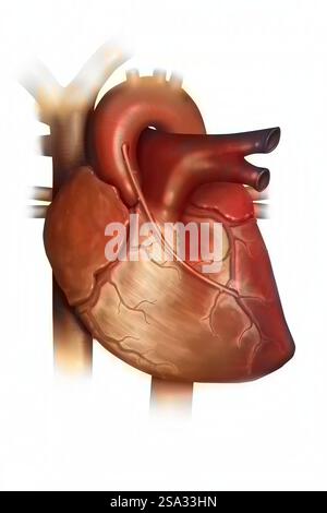 Innesto di bypass coronarico. L'ostruzione di un vaso coronarico in giallo da una placca ateromatosa viene compensata dal posizionamento di un bypass. Foto Stock