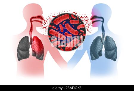 Tubercolosi focolaio e trasmissione TB come infezione batterica contagiosa a causa di batteri Mycobacterium che infettano i polmoni e altre parti del Foto Stock