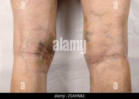 Gambe di donna dopo un intervento chirurgico di vena varicosa, con suture chirurgiche visibili punti e ferite su una gamba. Trattamento curativo, procedure estetiche, trombosi Foto Stock