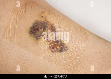 Gambe di donna dopo un intervento chirurgico di vena varicosa, con suture chirurgiche visibili punti e ferite su una gamba. Trattamento curativo, procedure estetiche, trombosi Foto Stock