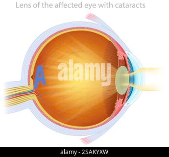 Illustrazione della cataratta oculare, che è la progressiva opacizzazione della lente, che causa una visione offuscata e una diminuzione dell'acuità visiva. Foto Stock
