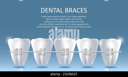 Modello per banner per poster vettoriale con bretelle dentarie. Denti bianchi realistici con staffe in metallo. Trattamento ortodontico, concetto di correzione del morso... Modello di design per striscioni per poster vettoriali Illustrazione Vettoriale