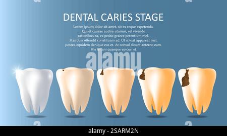Carie dentarie fasi vettoriale medico poster modello banner. Denti bianchi sani e denti cattivi affetti da carie. Igiene orale, concetto di stomatologia... Carie dentarie fasi vettoriale medico poster modello banner Illustrazione Vettoriale