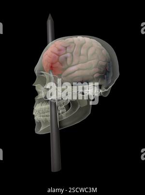 Phineas Gage (luglio 1823-maggio 1860) è stato un operaio ferroviario statunitense noto per essere sopravvissuto a una traumatica lesione cerebrale causata da un'asta di ferro che gli ha sparato attraverso il cranio e ha distrutto la maggior parte del lobo frontale sinistro del suo cervello. Si dice che la lesione abbia causato importanti cambiamenti alla sua personalità, rendendolo un caso di riferimento nella neuroscienza. Foto Stock