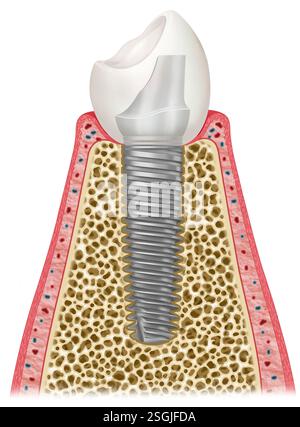 Illustrazione schematica dell'interno di un dente, dove possiamo vedere un impianto dentale e i diversi elementi che lo compongono. Foto Stock