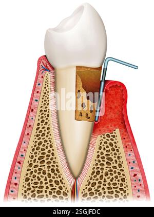Rappresentazione di un dente affetto da malattia parodontale (gengivite) nelle sue fasi avanzate. Foto Stock