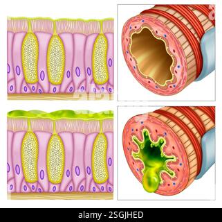 Diagramma di due segmenti bronchiali. Uno con bronchite acuta, infiammazione dei bronchi, causata da virus, e l'altro sano. Foto Stock