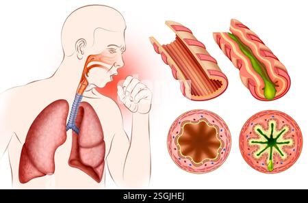 Composizione di una persona tosse e bronchi infiammati a causa di asma, una malattia cronica che provoca infiammazione e restringimento dei bronchi. Foto Stock
