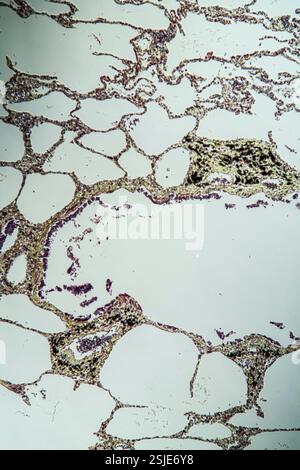 Tessuto polmonare con asma al microscopio Foto Stock