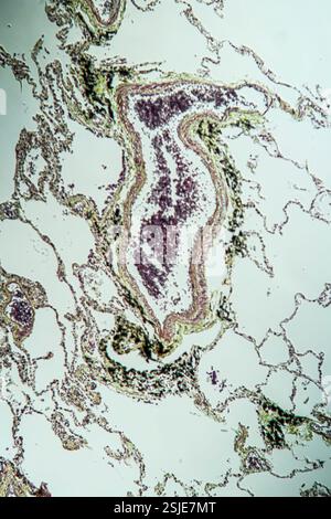 Tessuto polmonare con asma al microscopio Foto Stock