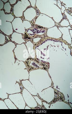 Tessuto polmonare con asma al microscopio Foto Stock