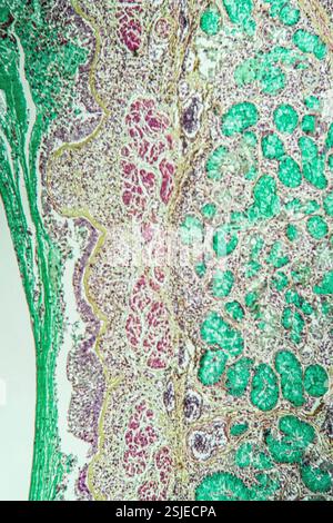 Polmoni con tessuto asmatico al microscopio Foto Stock