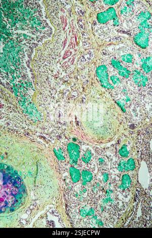 Tessuto polmonare con asma al microscopio Foto Stock
