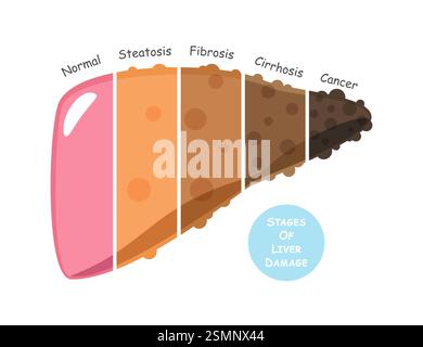Gli stadi di danno epatico includono steatosi o steatosi epatica, fibrosi, cirrosi e cancro o carcinoma epatocellulare . Design piatto . Vettore . Illustrazione Vettoriale