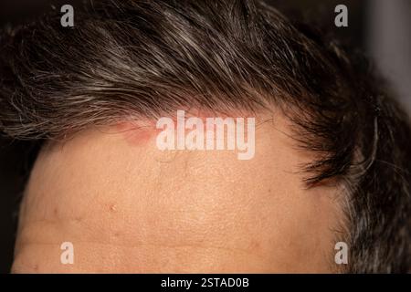 Le macchie cutanee appaiono sul cuoio capelluto di una persona che soffre di psoriasi, riflettendo le lotte di questa condizione cronica Foto Stock