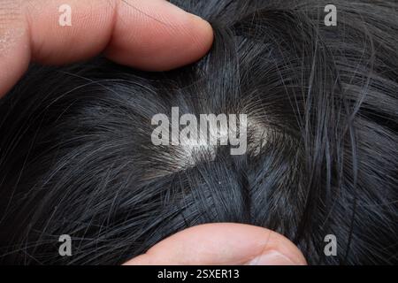 Primo piano di un medico che esamina il cuoio capelluto di un paziente, controlla la perdita di capelli, cerotti calvi e potenziali segni di alopecia Foto Stock
