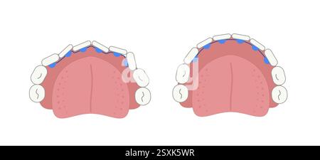 Bretelle linguali nella bocca sulla superficie interna del dente prima e dopo il grafico. Immagine geometrica semplice e piatta. Illustrazione Vettoriale