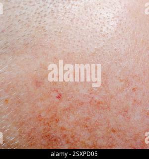 Cheratosi attinica o carcinoma basocellulare sul cuoio capelluto di un adulto Foto Stock