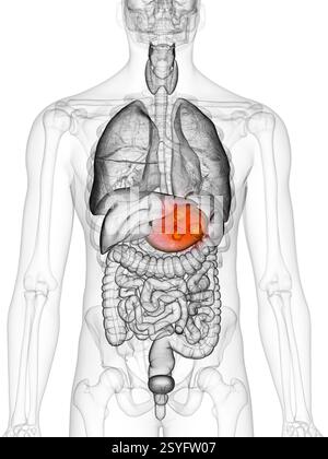 Il cancro dello stomaco, illustrazione. Foto Stock