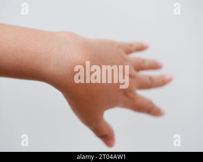 cisti del ganglio su mano di donna isolata su sfondo bianco Foto Stock