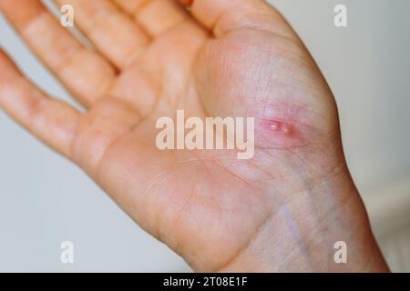 herpes sulla mano di una donna di palma Foto Stock