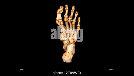 Foot 3D Scan for diagnosis foot diseases by CT-SCANNER . Foto Stock