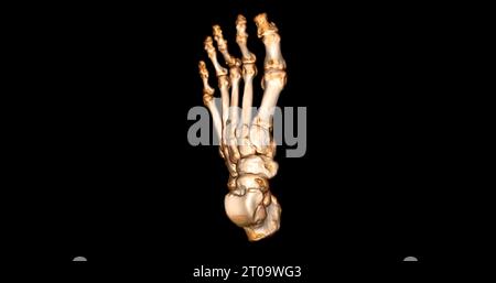 Foot 3D Scan for diagnosis foot diseases by CT-SCANNER . Foto Stock