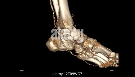 Foot 3D Scan for diagnosis foot diseases by CT-SCANNER . Foto Stock