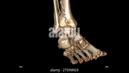 Foot 3D Scan for diagnosis foot diseases by CT-SCANNER . Foto Stock