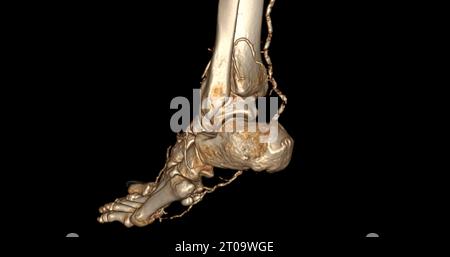 Foot 3D Scan for diagnosis foot diseases by CT-SCANNER . Foto Stock