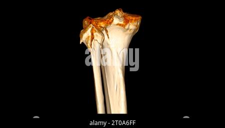 Scansione TC dell'articolazione del ginocchio che mostra la frattura tibia e il rendering 3D dell'osso della fibula. Foto Stock