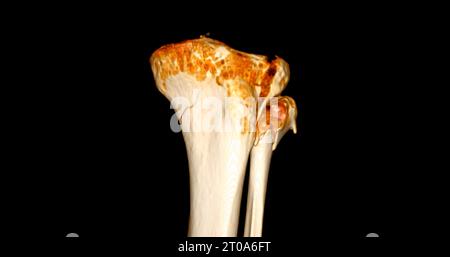 Scansione TC dell'articolazione del ginocchio che mostra la frattura tibia e il rendering 3D dell'osso della fibula. Foto Stock