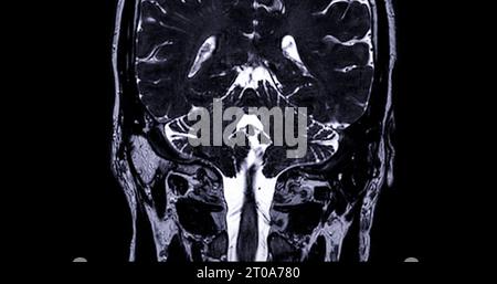 Risonanza magnetica del canale uditivo interno (IAC) . Foto Stock