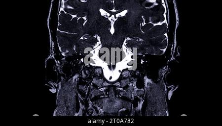 Risonanza magnetica del canale uditivo interno (IAC) . Foto Stock