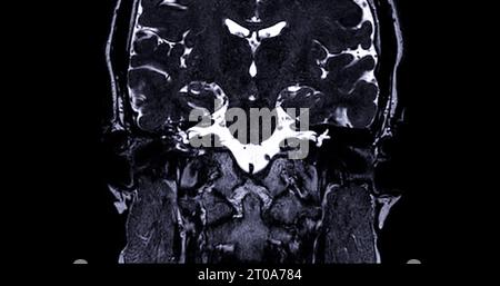 Risonanza magnetica del canale uditivo interno (IAC) . Foto Stock