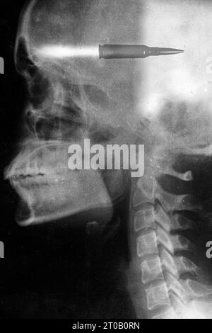 Radiografia di un teschio femminile con un proiettile in testa, sparato alla testa, pistole e morte Foto Stock