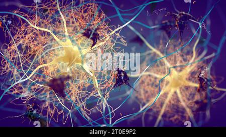Placche amiloidi che si formano tra neuroni. Proteina beta-amiloide che disturba la funzione delle cellule nervose in un cervello con malattia di Alzheimer Foto Stock
