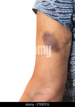 Braccio senior con lividi. Donna con grandi segni blu e viola dovuti a caduta o incidente. O contusioni per motivi medici come fluidificante del sangue, vita Foto Stock