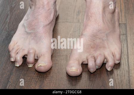 I martelli deformati dell'uomo mostrano il piede sinistro un anno dopo l'intervento Foto Stock