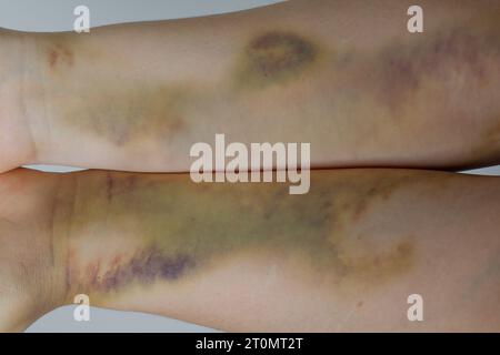 Un grosso livido sulle mani della donna da vicino Foto Stock