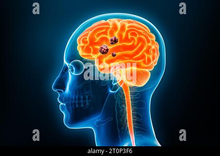 Cancro del cervello umano con cellule cancerose o tumori rappresentazione 3D a raggi X con corpo. Anatomia, patologia del sistema nervoso, medico, oncologia, bio Foto Stock