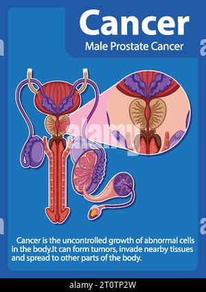 Infografica che illustra le differenze tra cellule prostatiche normali e cancerose Illustrazione Vettoriale