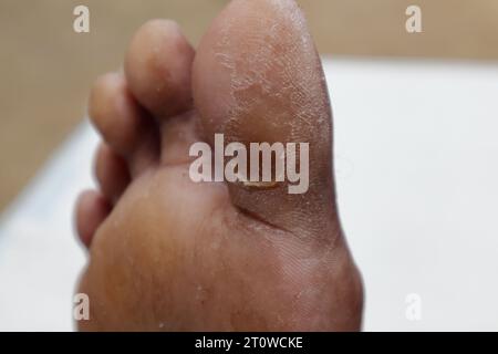 Vista ravvicinata di un'ulcera diabetica del piede completamente guarita sul lato inferiore di un'alluce Foto Stock